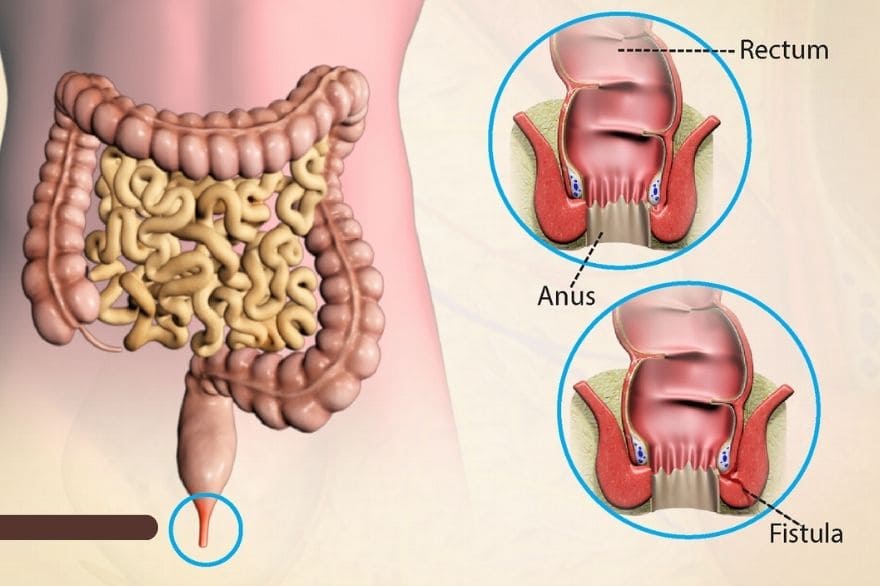 Fistula in ano