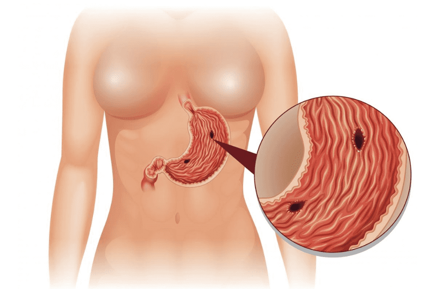 Intestinal perforation (Gastric & Enteric)