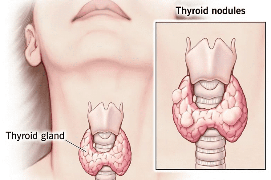 Thyroid Nodule