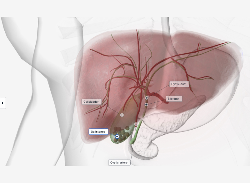 Gall bladder stones